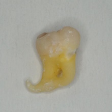 Leczenie endodontyczne Radom