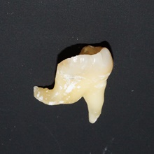 Leczenie endodontyczne Radom