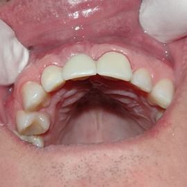 implanty stomatologiczne Radom