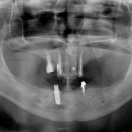 implanty stomatologiczne