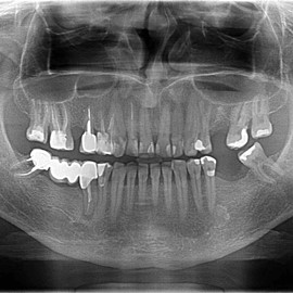 implanty zębowe Radom