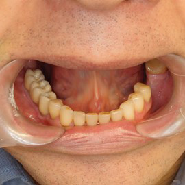implanty zębowe Radom