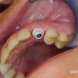Odbudowa zęba na implancie