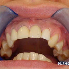 implanty stomatologiczne Radom