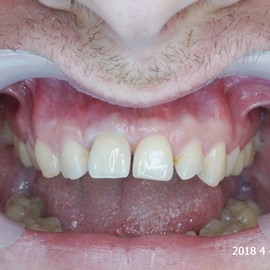 uzupełnienia zębów przednich Radom