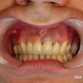 utrata zębów implanty