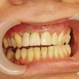 utrata zębów implanty
