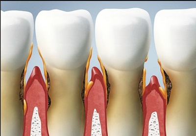Poziome zaniki kości wyrostka zębodołowego otaczającej zęby