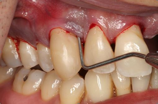 Paradontoza a ortodoncja