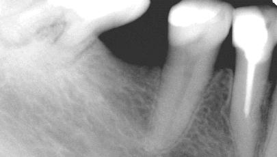 Endodoncja Radom