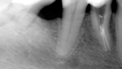 Endodoncja Radom