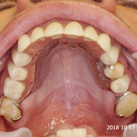 Proteza nakładowa over-denture